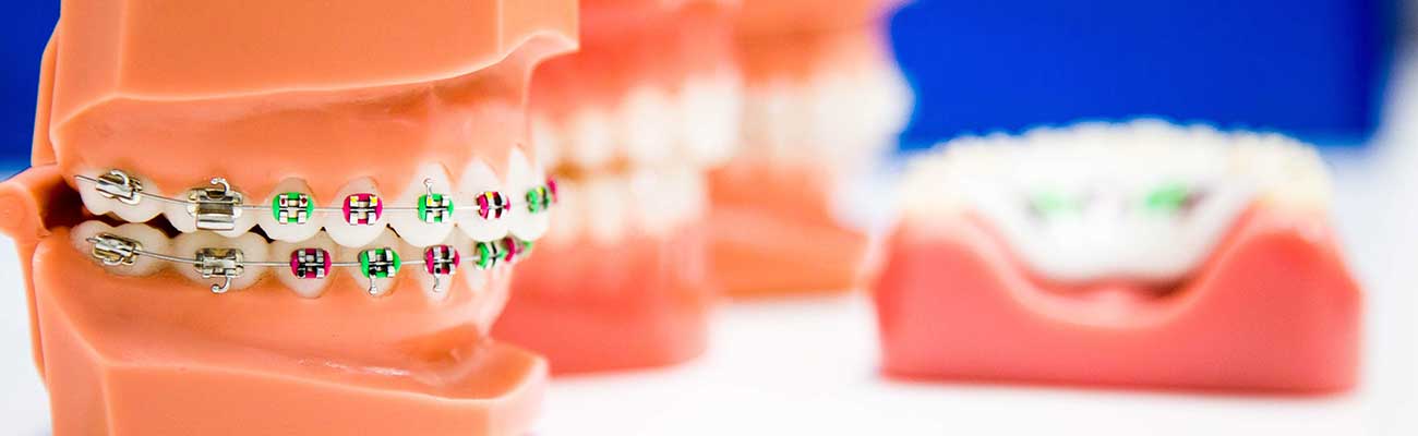 A selection of orthodontic appliances used at Pinecrest Orthodontics