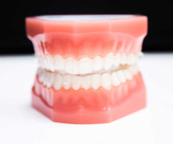 Invisalign aligners displayed on a dental model