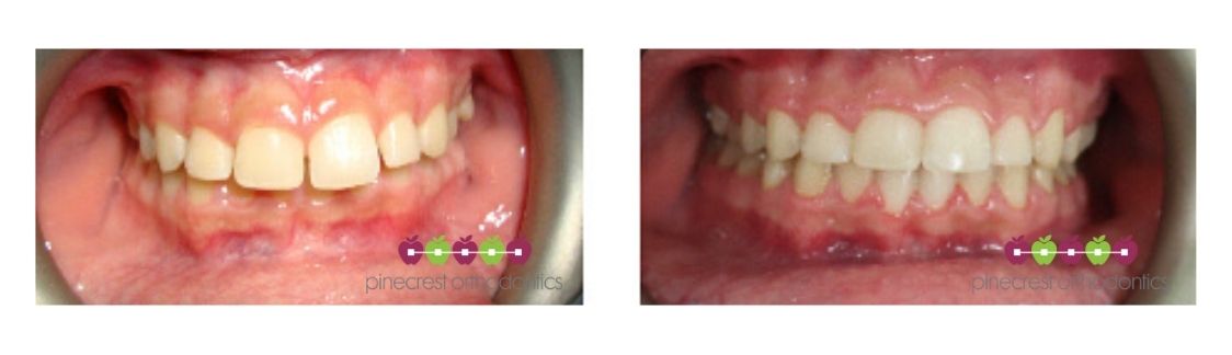 excessive overbite pinecrest