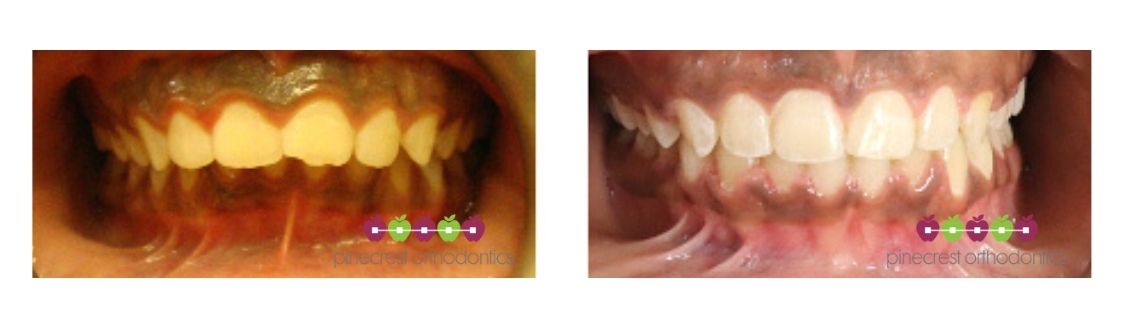 fix deep overbite pinecrest