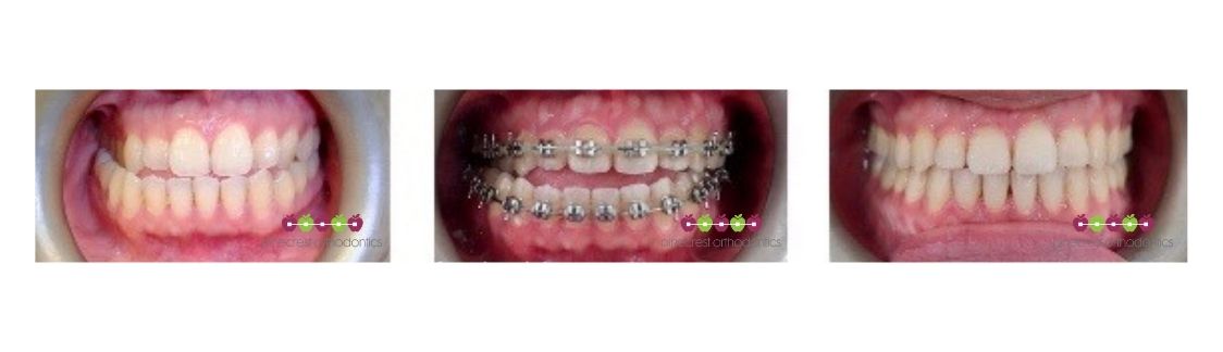 braces and jaw surgery pinecrest