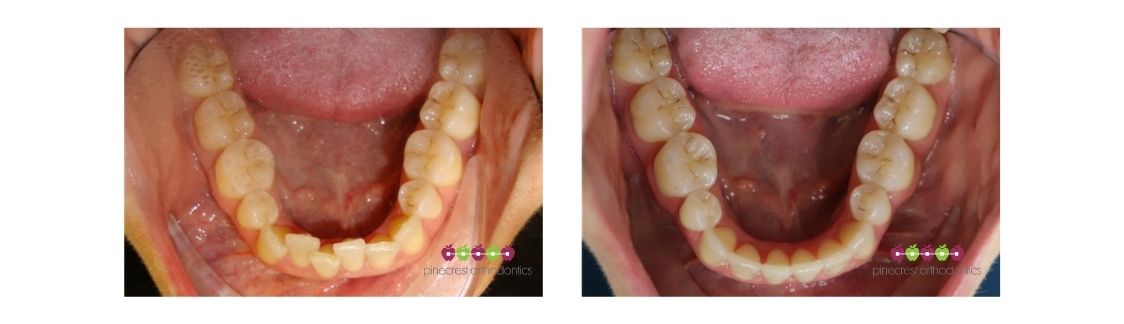 fix bottom teeth pinecrest