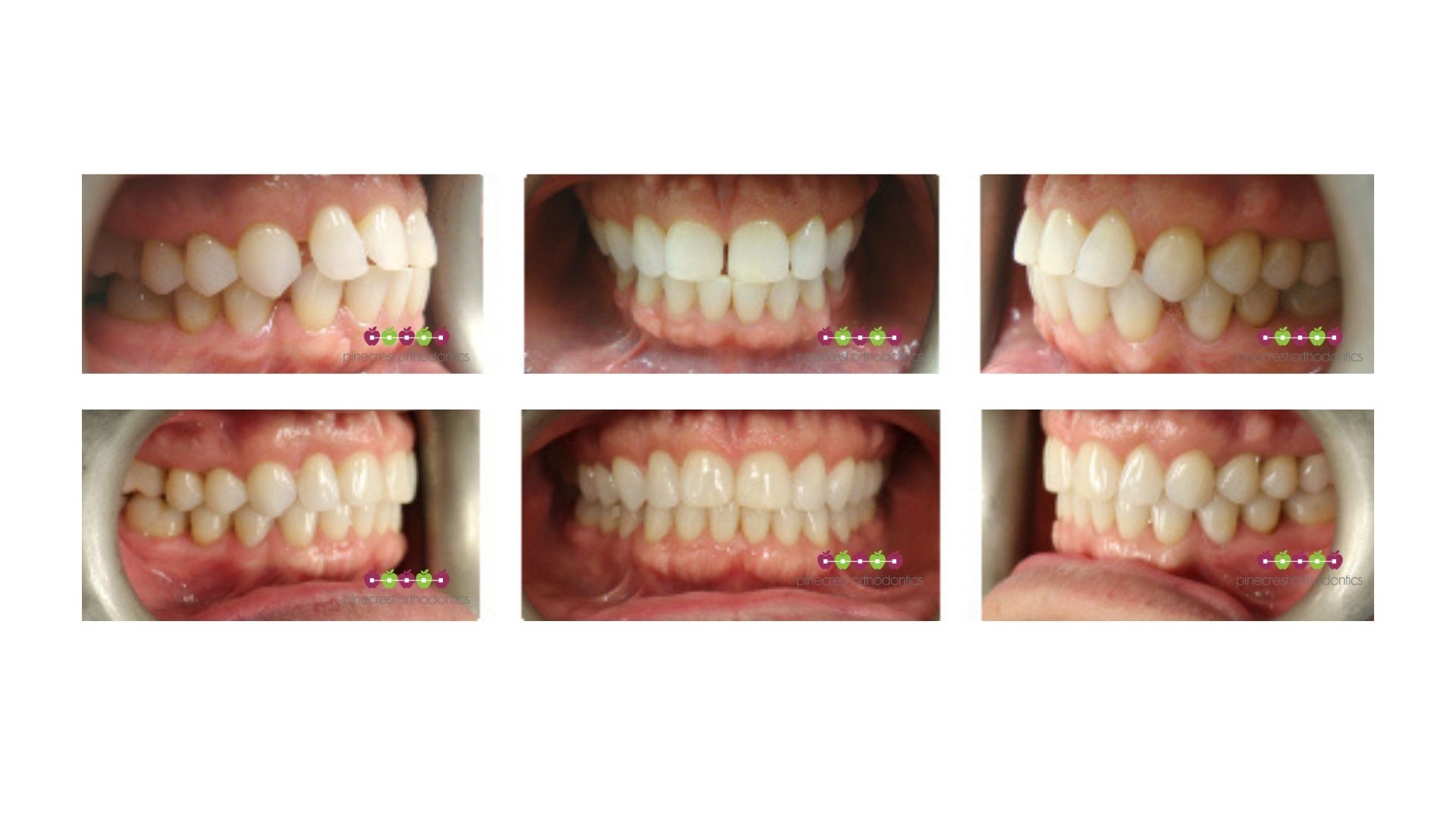 pinecrest invisalign