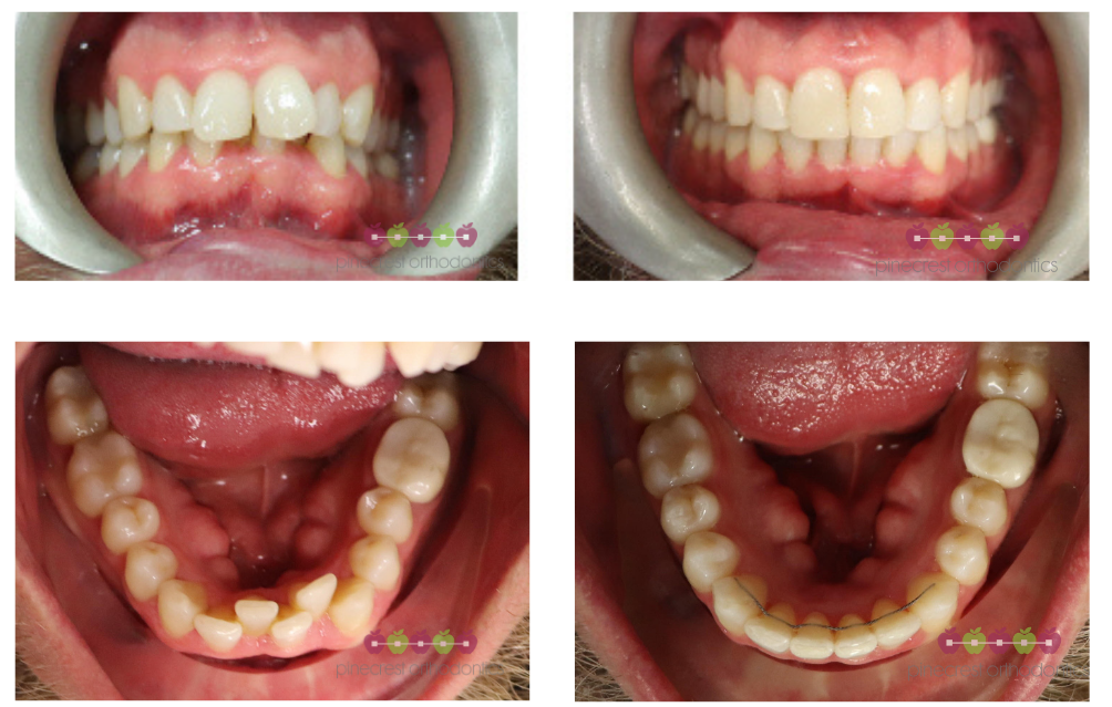 19 months invisalign