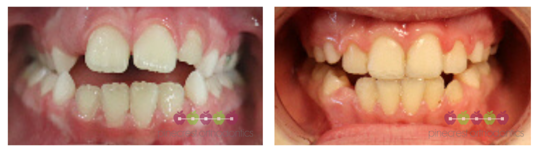 phase 1 orthodontics