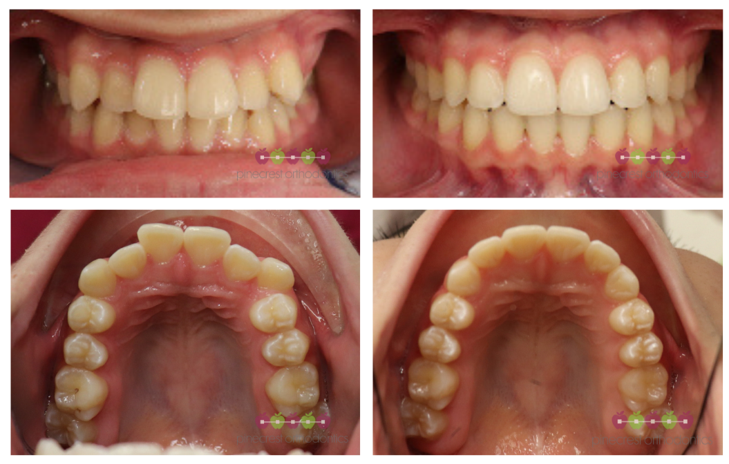 invisalign teen