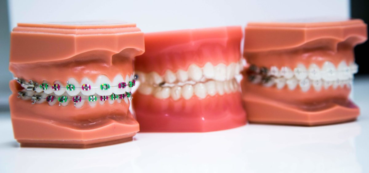 Braces Options