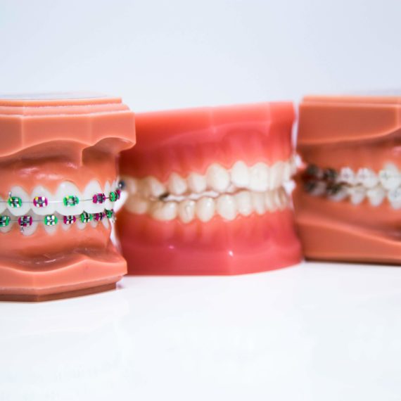 Braces Options