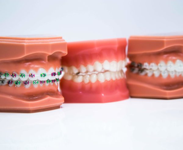 Braces Options