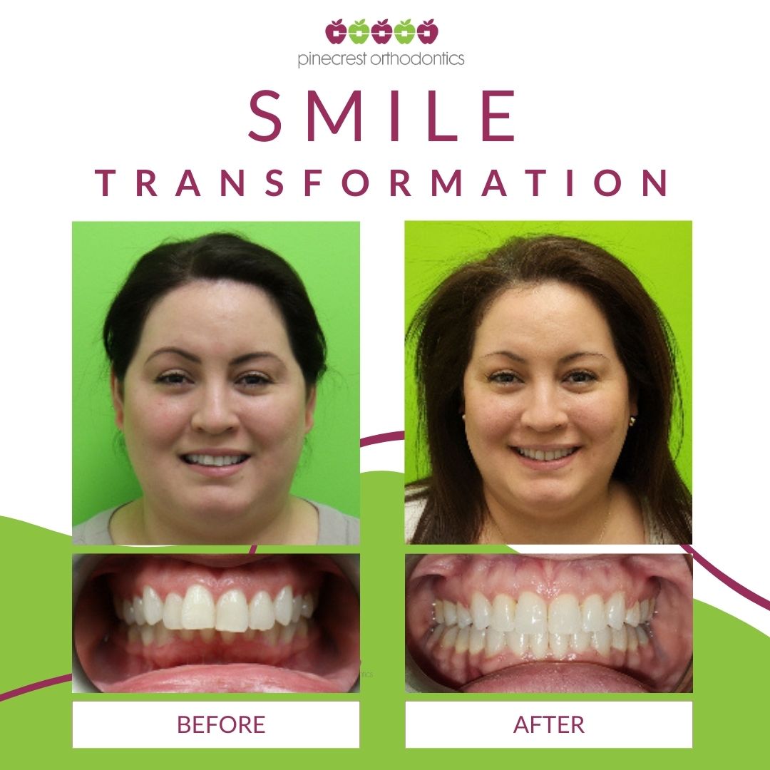 Before and after adult braces results at Pinecrest Orthodontics