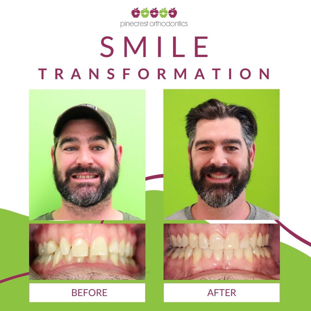 Before and after adult Invisalign results at Pinecrest Orthodontics