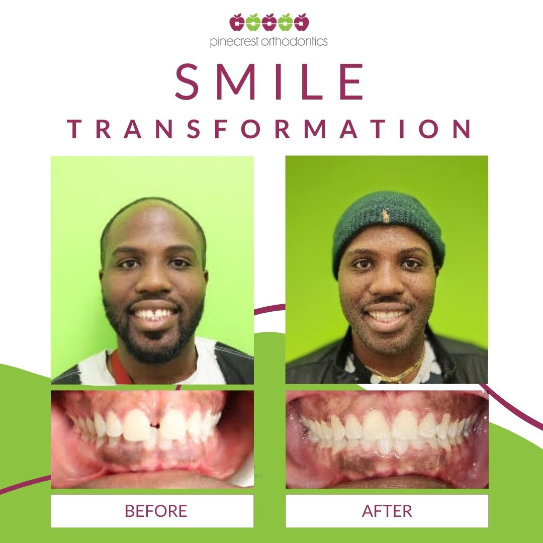 Before and after adult braces smile transformation at Pinecrest Orthodontics