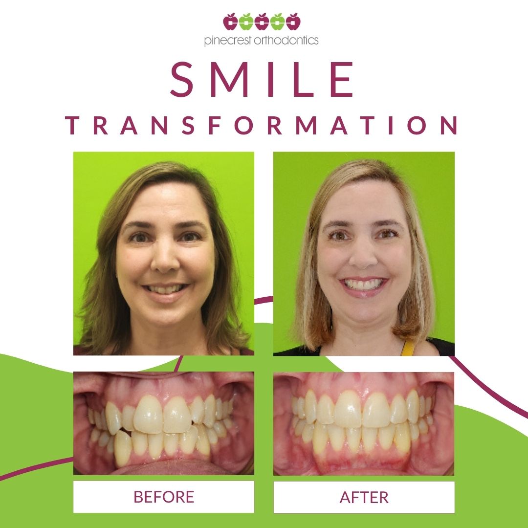 Before and after adult Invisalign smile transformation