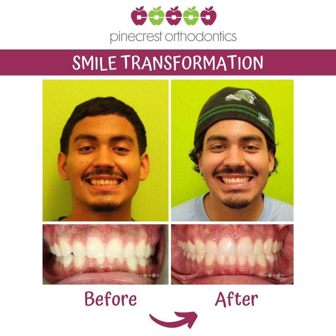 Before and after Invisalign clear aligner smile transformation