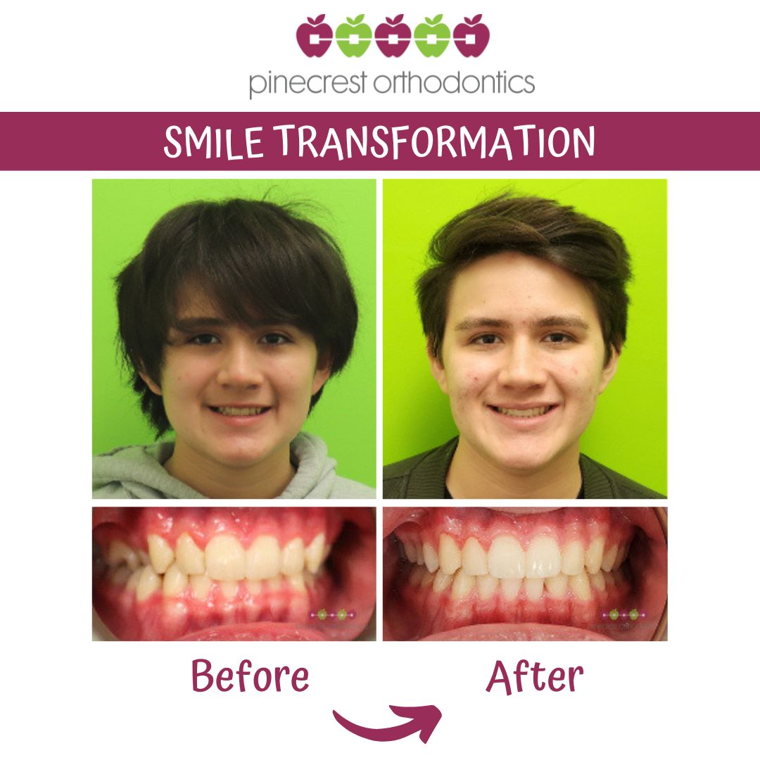 Before and after Invisalign Teen results at Pinecrest Orthodontics