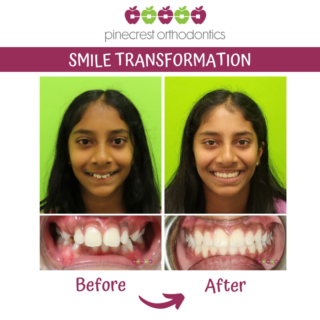 Before and after teen braces results at Pinecrest Orthodontics