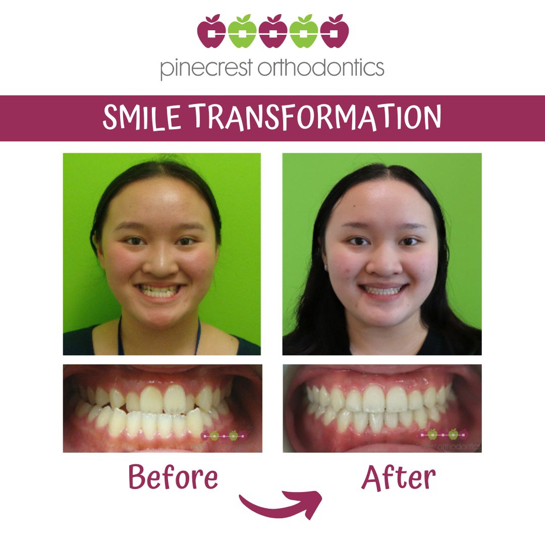 Before and after teen braces smile transformation at Pinecrest Orthodontics